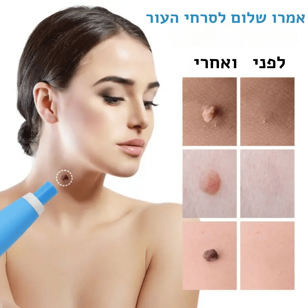 SEFUDUN – ערכת הסרת סרחי עור, שומות ופלולות אוטומטית | ערכת הסרת סרחי עור, שומות ופלולות אוטומטית | אוזו - שופ